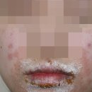 버팀목한의원 | 청주 습진치료 한의원 혼동하기 쉬운 손발 수포 질환 구분해야죠