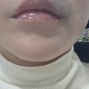 바이린 글로벌 | [피부] 바이오플러스 스킨부스터 '휴그로' 가격·장점