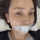 멍이와 양이 | [입술필러 후기] 얇은 입술, 최소 2cc는 받아야 하는 이유 (feat. 1.6cc 리얼 경험담)