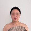 포미짐 | 마포 에스테틱 추천 포미 Formi 윤곽 이중턱 페이스 컨투어링 솔직후기