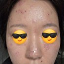 라르떼의원 | 수유 라르떼의원 점빼기 피지과다증 제거 내돈내산 후기