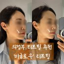 의정부 리프팅 솔직후기, '미글로우'로 무너진 이중턱 처진라인 정리하고 작은얼굴 완성!