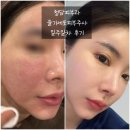 자꾸땡겨 | 청담피부과 줄기세포피부주사 일주일차 내돈내산 전후 후기
