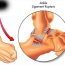 발목 염좌 과 원인 대법까지 알아봐요 이미지