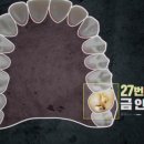 아라치과기공소 네이버블로그