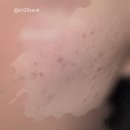 펄스코 | 강남역피부과 추천 울트라펄스알파 co2 레이저 여드름흉터치료 내돈내산 후기