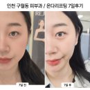 7 | 인천 구월동 피부과 '온다리프팅' 7일 솔직후기 (효과시기, 통증, 장점)