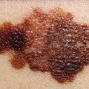 악성 흑색종[malignant melanoma] 이미지