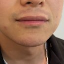 촉촉이네 | [내돈내산] 촉촉이 아빠 부산 센텀시티 남성 레이저 제모 3회차~5회차 솔직후기