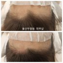 수정헤어라인 네이버블로그