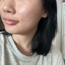 청담스킨부스터 디오디청담 엑소좀 시술 좁쌀여드름피부에 추천해요