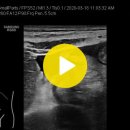 골반염(Pelvic inflammatory disease)에 의한 경미한 복수(ASCITES) 이미지