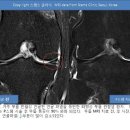연골판 파열2 이미지