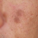 레이크봄봄피부과의원 | 대전피부과점빼기, 잘못 빼면 흉터생기는 이유