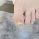 작전역 발톱무좀 전문샵 발관리는 레푸스부평CGV점