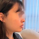 강남 피부과에서 턱선, 목쳐짐 2세대 마이크로 웨이브 미글로우리프팅 후기