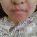 코디케어 | 코디케어로션 2.5% 발라보니까요..