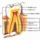 치수염(pulpitis) ﻿ 이미지