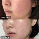 멍, 타임 | 리투오 후기, 다운타임, 통증, 멍, 효과 - 목동 오목교 피부과 스킨부스터 리뷰