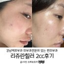 두꺼비술방 | 강남피부과 리쥬란힐러2cc후기 모공 줄어들었어요