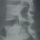 척추분리증(spondyloysis), 척추전방전위증(spondylolisthesis) 이미지