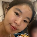 앞트임재복원(앞트임재재건) 내돈내산 / 손품 발품 / 수술당일~3개월차(90일째)