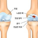 검지손가락 마디 통증 부음 떨림 저림 원인 이미지