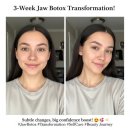 평온치과의원 | 이갈이 보톡스 후기, 3주 후 솔직 변화