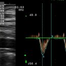 Lt VA orifice stenosis 이미지