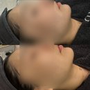 잠실에스테틱 가희하다에서 이중턱 관리 받고 온 후기