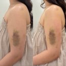 내서점기아오토큐 | 대전 웨딩관리 추천｜이유 에스테틱 바디에어핏 팔뚝관리 솔직 후기