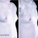 여성형유방 치료를 위한 초음파 지방흡입술 (이렇게 수술한다가 아니라 잘못된 케이스입니다) 이미지