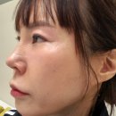 NO.1 자동차피부과 | 신사역피부과 실리프팅 받고 30대로 보인 리얼 후기