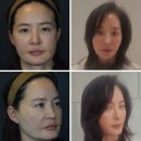 가나 | 가나브이 후기｜실리프팅·엘라스티 필러 복합시술(실트라) 65일 경과 기록