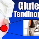 중둔근 건병증(Gluteal Tendinopathy) 증상, 원인, 그리고 대전자 통증(Greater Trochanter Pain) 이미지