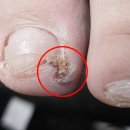 라니멍 | 광주 내성발톱 숨은 발톱 이것때문이라니 충격 후기