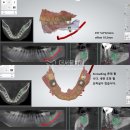 성남 치과의원 에서 임플란트를 받았던 환자, 반대쪽 치아가 부러져서 재내원하셨습니다.
