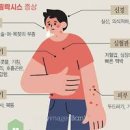 아나필락시스 효능 및 증상 쇼크 에피네프린 주사 이미지