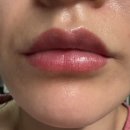 내일의원 | 내돈내산) 이태원 엘리엇의원 인생 첫 입술필러 후기 입술필러붓기