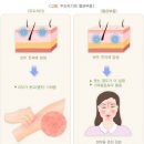 두드러기에 좋은음식과 나쁜음식 이미지