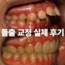 다인치과의원 | 앞니 사이 벌어짐 돌출 교정? 공간과 돌출을 함께 살핀 교정 사례 / 돌출 교정 실제 후기