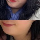세안의원 | 군산 피부과 바로그의원 윤곽주사 1회 인모드FX, 슈링크 후기