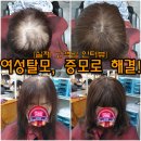 여성탈모, 탈모 병원 치료보다 효과적인 머리숱 많아지는 방법- 이식커버증모술