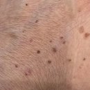 일상] 손등에 오돌토돌 퍼진 좁쌀의 정체?! 😱 수원 바를정한의원 편평사마귀 면역 치료 리얼 후기! ✨
