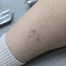 북부정형외과의원 | "50대 여성 환자분, 강아지에게 물리셨을 때 이렇게 치료했습니다 (광견병 주사 고민이라면 꼭 읽어...