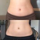 네오의원 | 강남다이어트 엠스컬프네오 + 지방분해주사 복부라인 단기 체형관리 후기