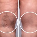 하지정맥류의 치료와 예방 이미지