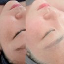 태중로 | [경기광주윤곽관리] 아픈 윤곽주사 대신 바르는 스킨부스터! 55세 리프팅 후기