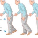 파킨슨병 초기증상,치료제,장애등급,좋은음식,원인,말기증상,수명,운동,진단,치매,유전 알아보자 이미지