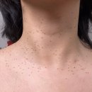 서울의원 | 서울 편평사마귀 성지 사려니의원 제거후기, 예약방법